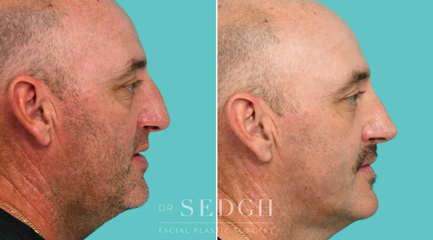 Patient 343 after Crooked Nose Surgery, view 1