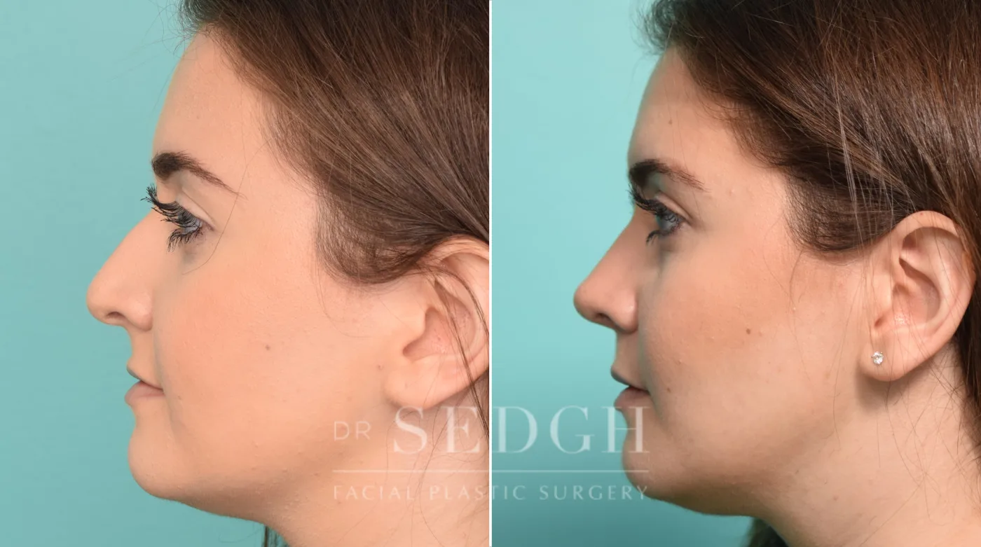 Patient 244 after Rhinoplasty, view 1