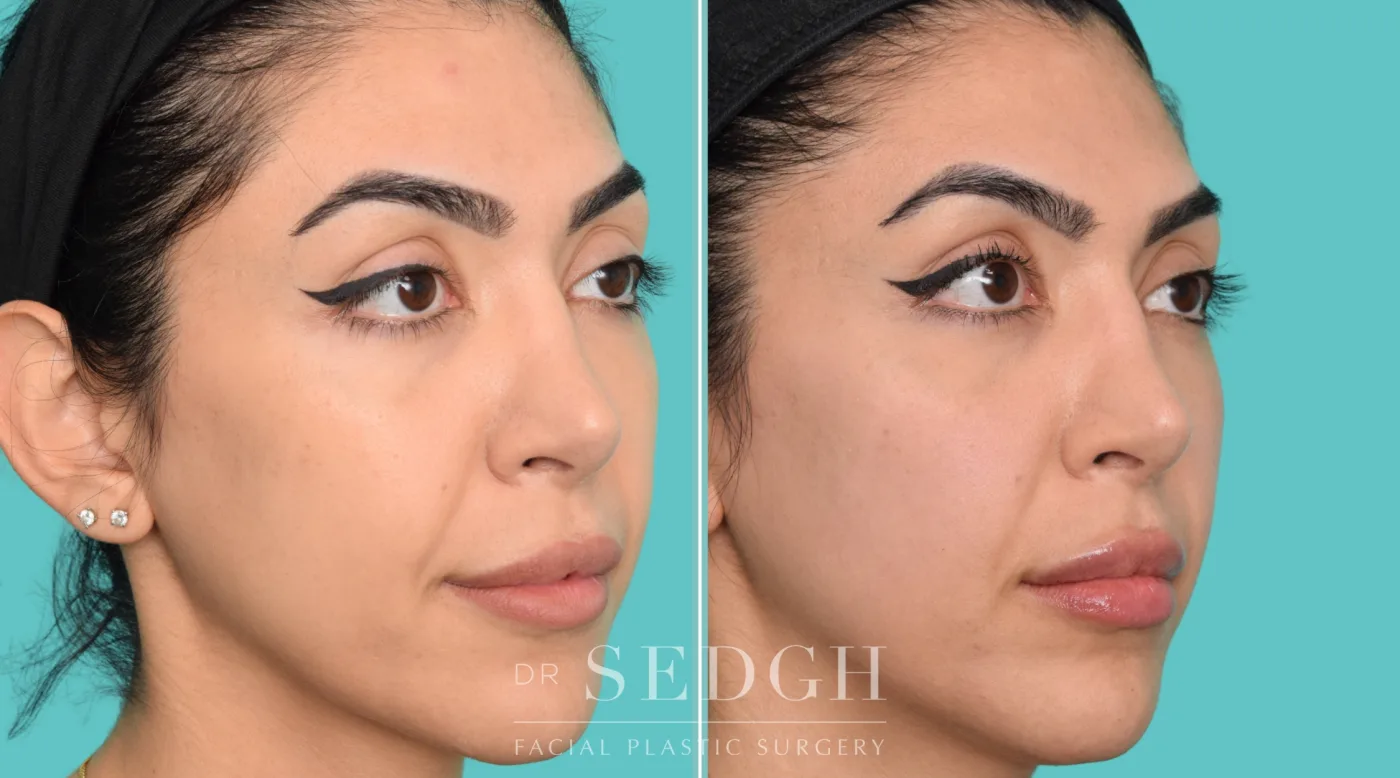 Patient 362 before Flat Helix Repair / Helical Reduction Otoplasty, view 2