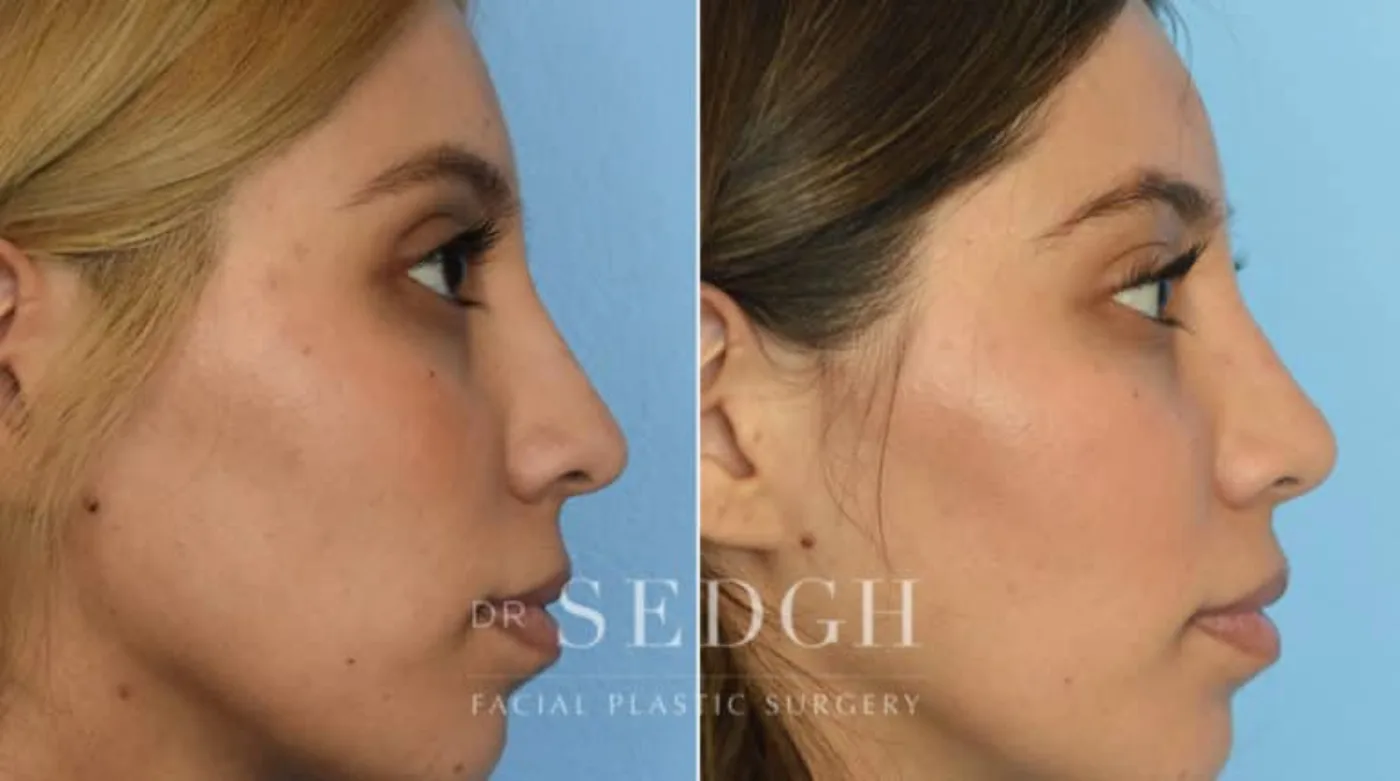 Patient 3 before Hispanic Rhinoplasty, view 1
