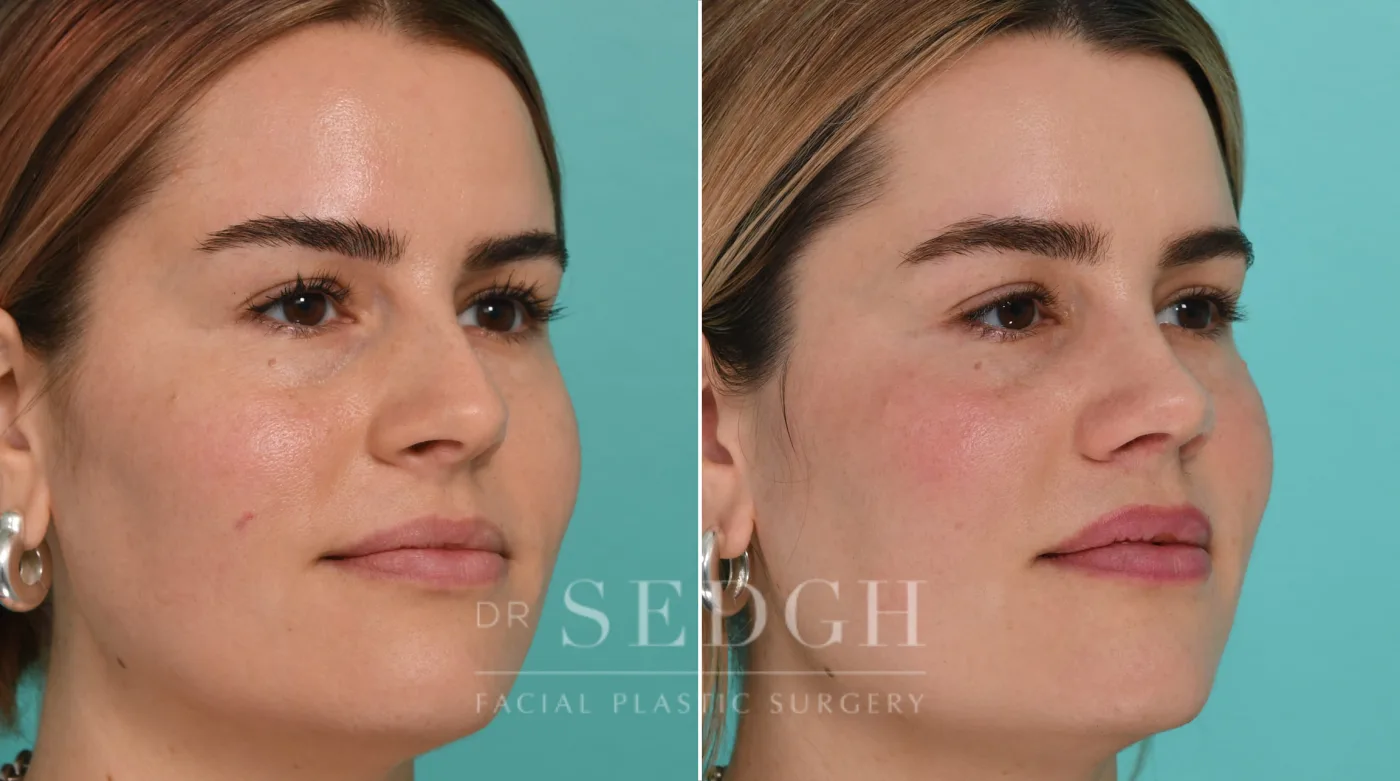 Patient 327 before Rhinoplasty, view 2