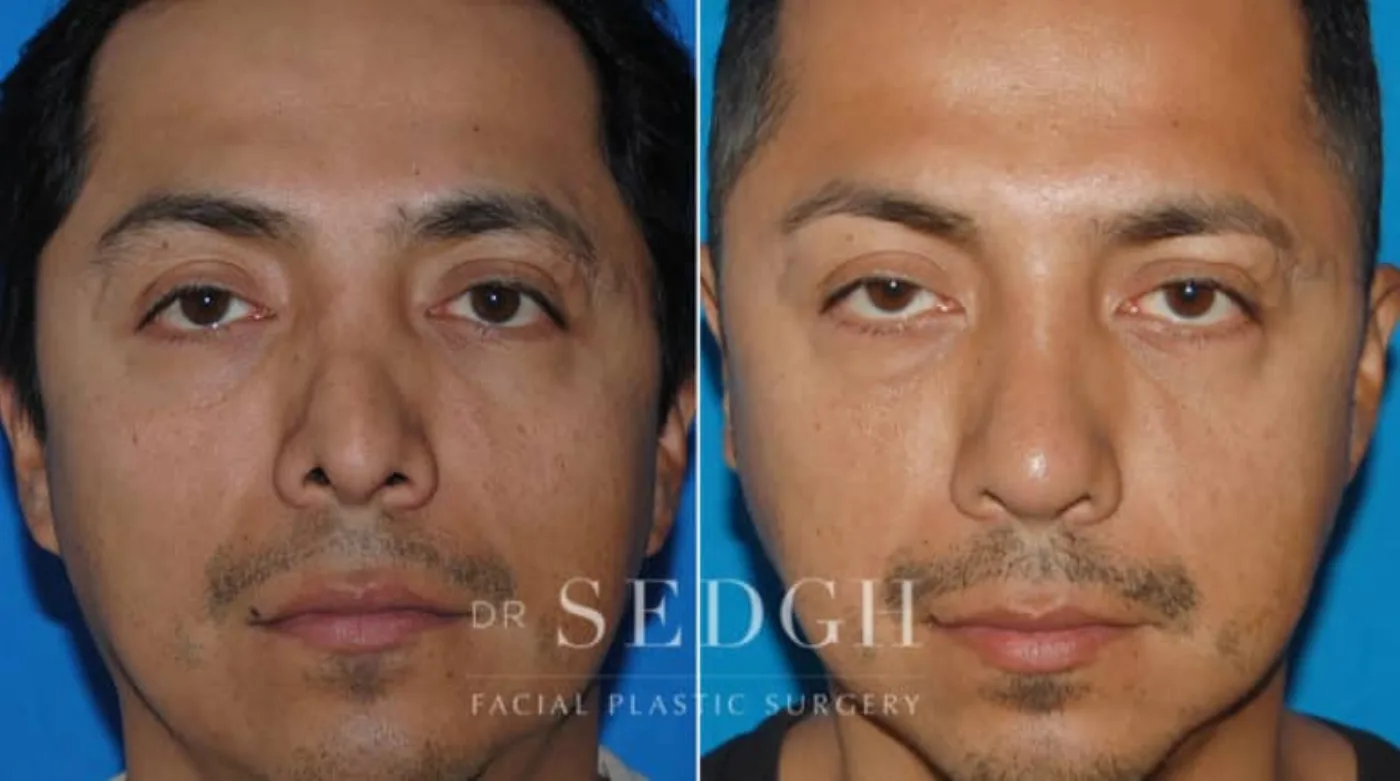 Patient 8 before Hispanic Rhinoplasty, view 1
