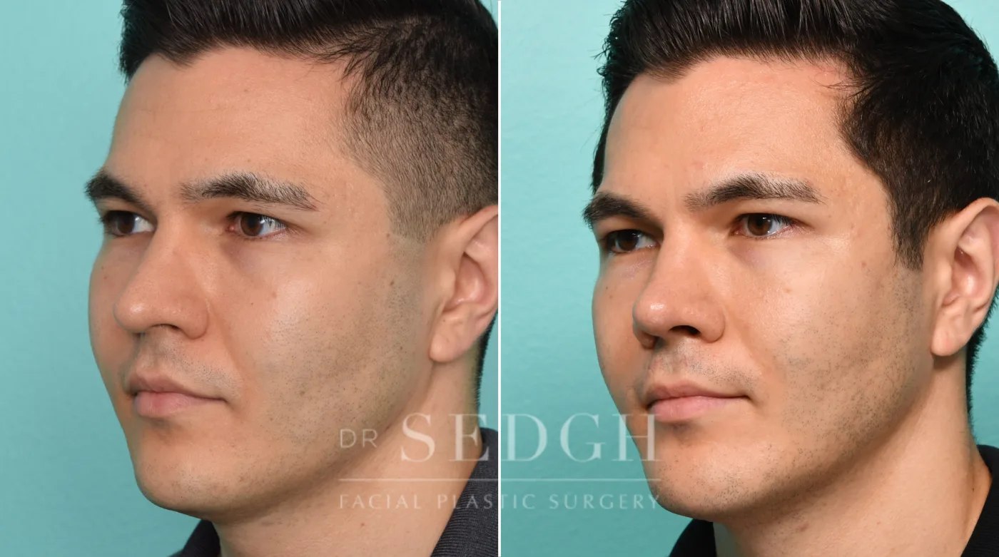 Patient 306 before Chin Augmentation, view 2