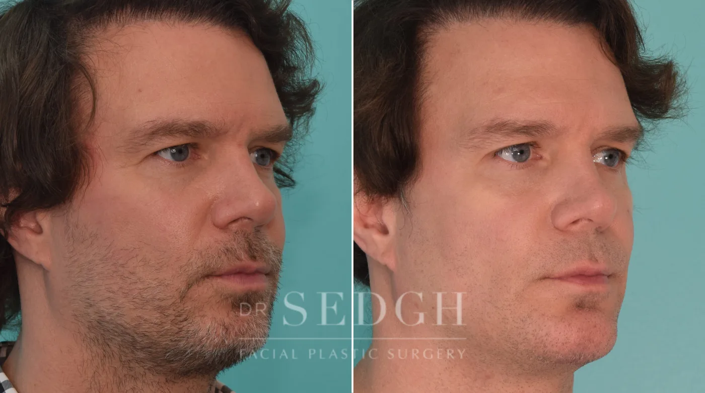 Patient 188 before Chin Augmentation, view 2