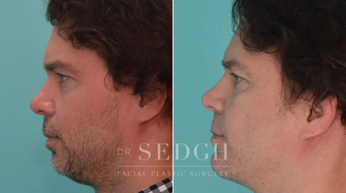 Patient 188 after Chin Augmentation, view 1