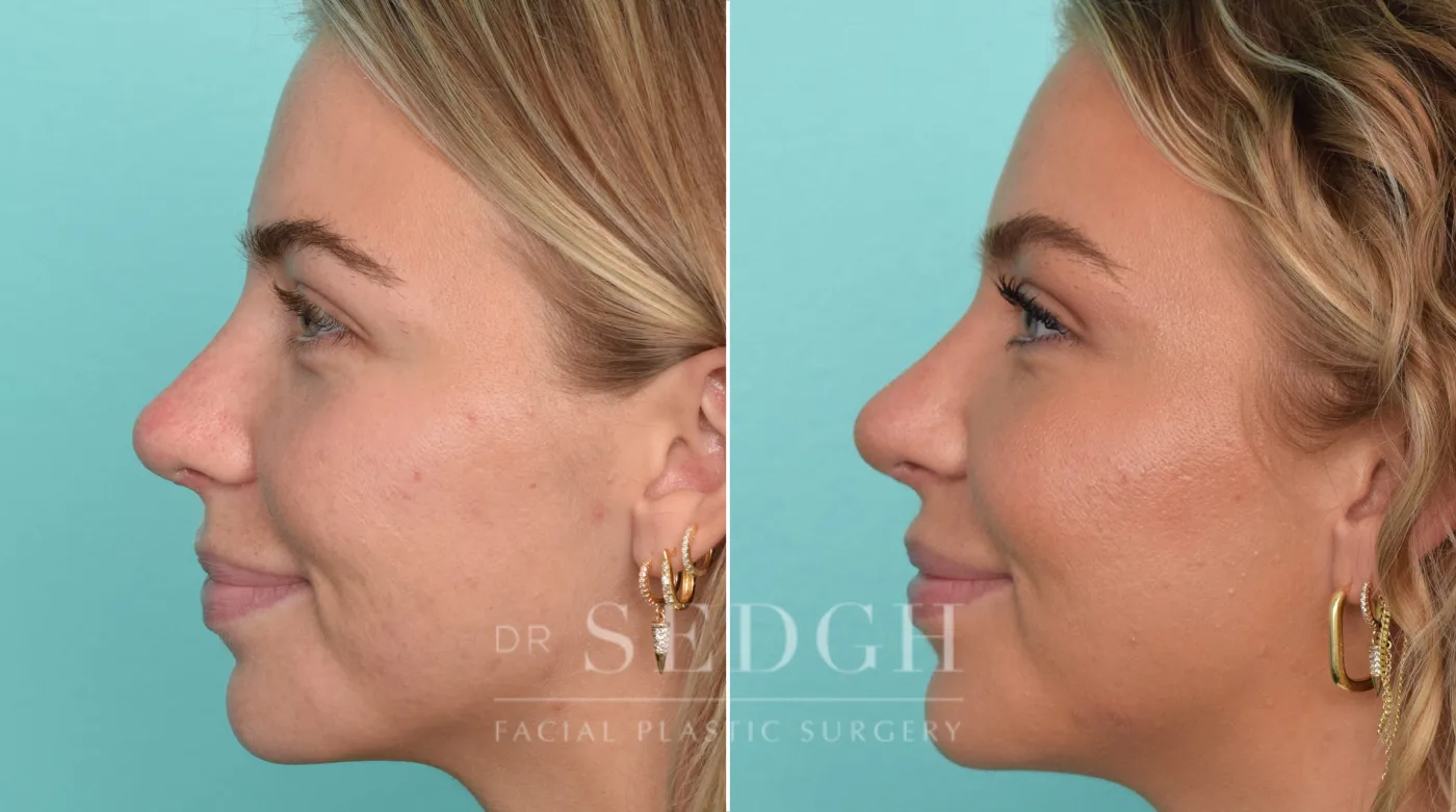 Patient 299 after Revision Rhinoplasty, view 2
