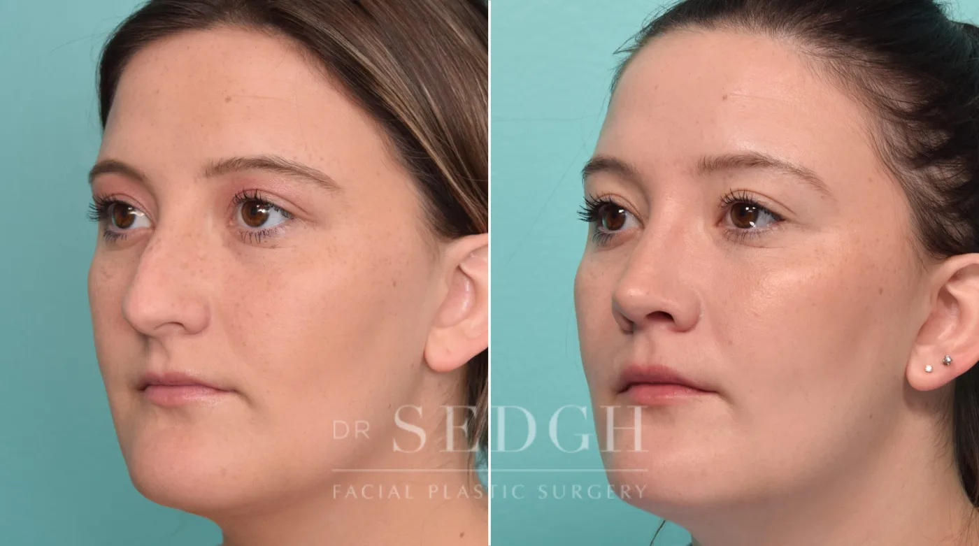 Patient 303 before Rhinoplasty, view 2