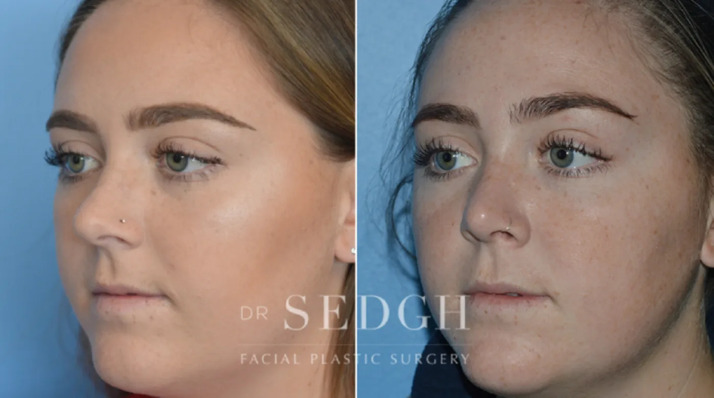 Patient 14 before Crooked Nose Surgery, view 2
