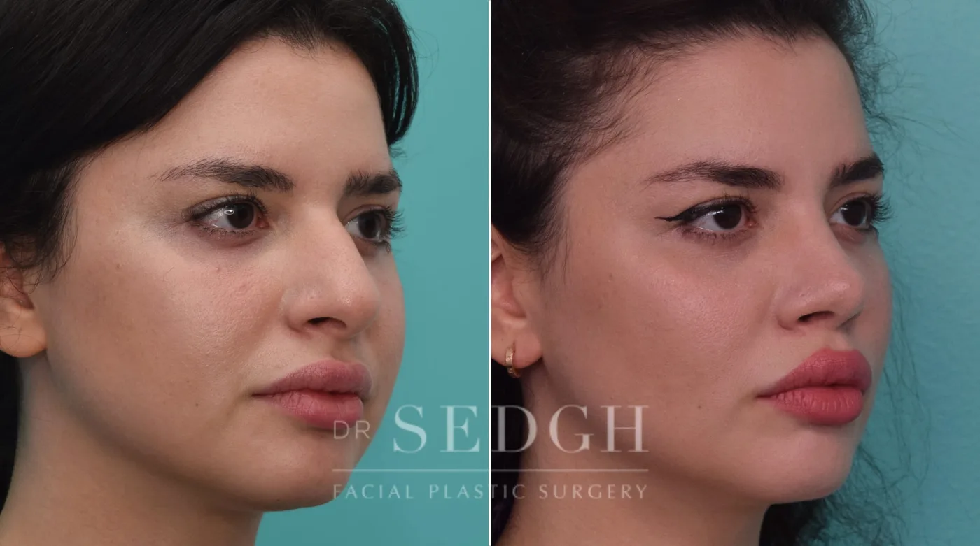 Patient 195 before Rhinoplasty, view 2