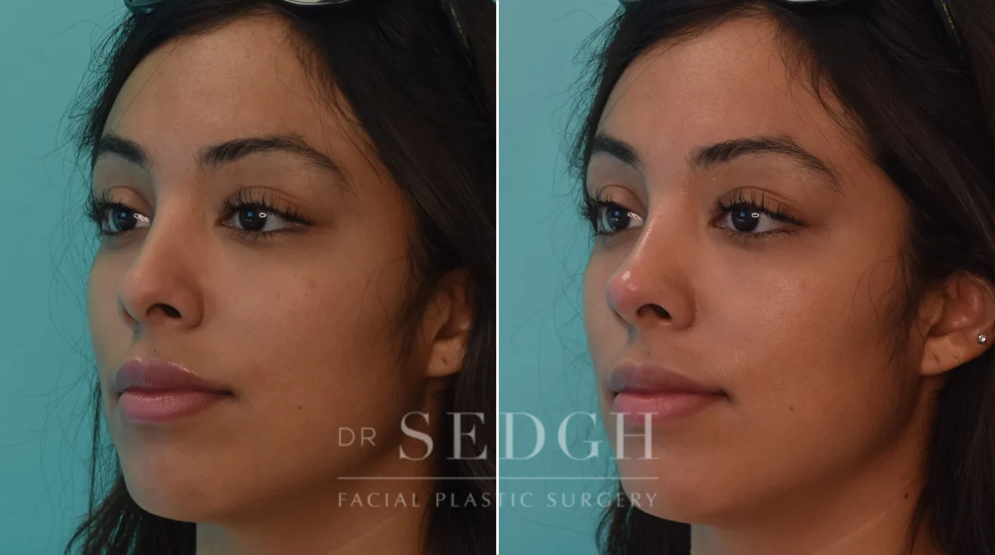 Patient 220 before Liquid Rhinoplasty, view 1