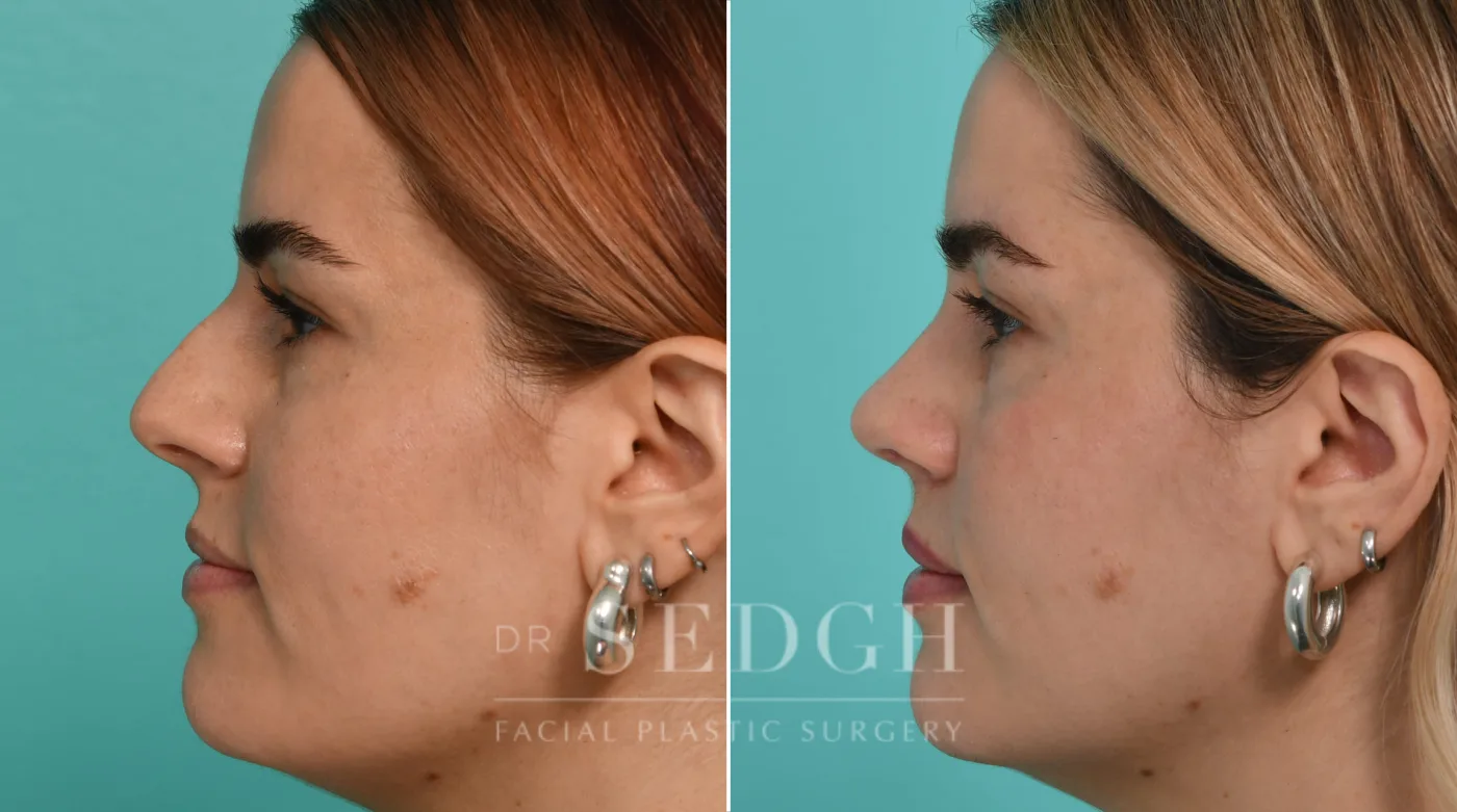 Patient 327 after Rhinoplasty, view 1