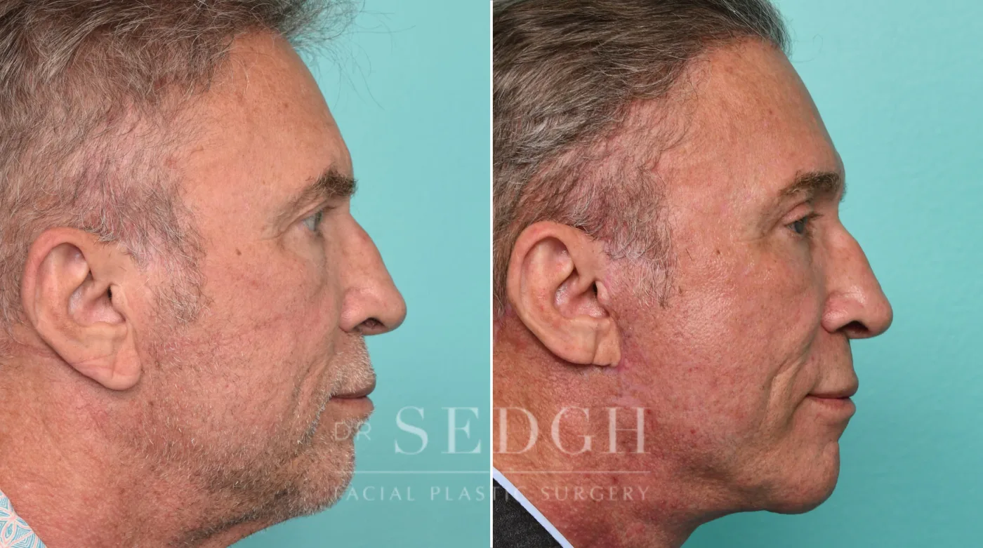 Patient 315 after Face Lift, view 2