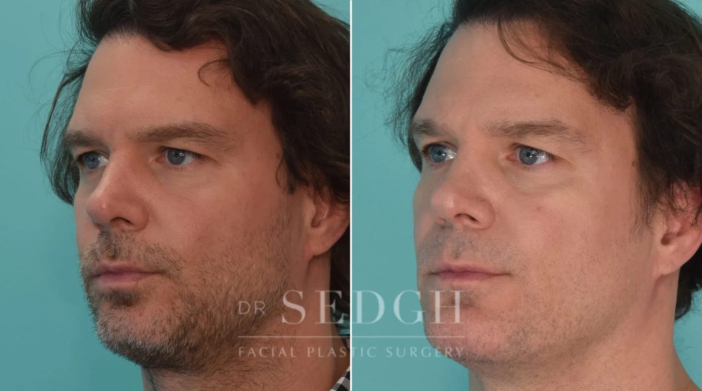Patient 188 before Chin Augmentation, view 1