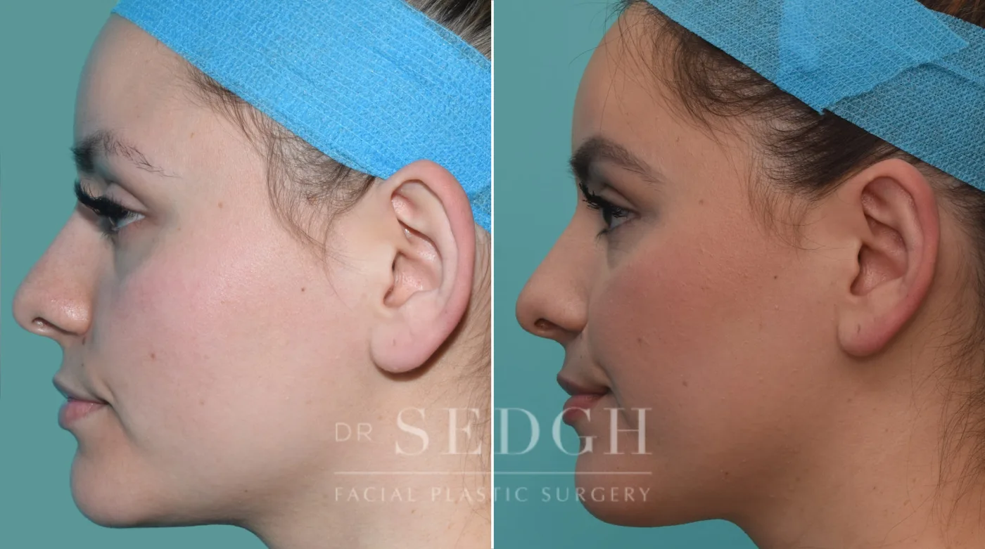 Patient 136 after Ear Pinning Surgery, view 1