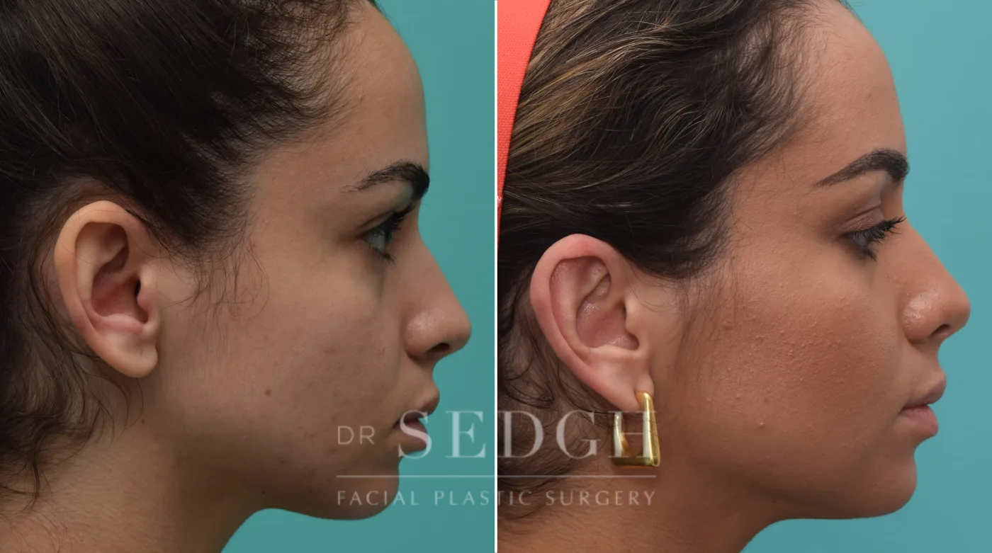 Patient 194 after Ear Pinning Surgery, view 2