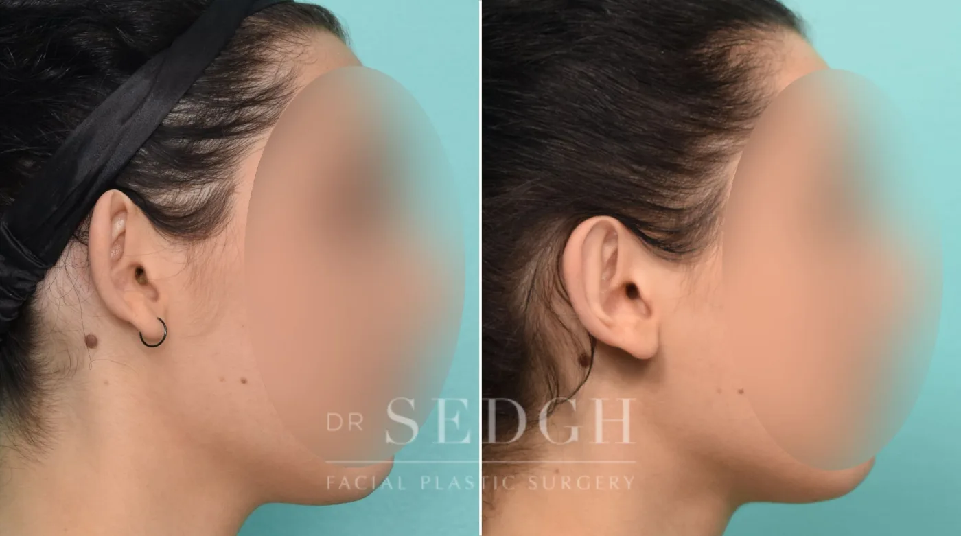 Patient 267 after Ear Pinning Surgery, view 2