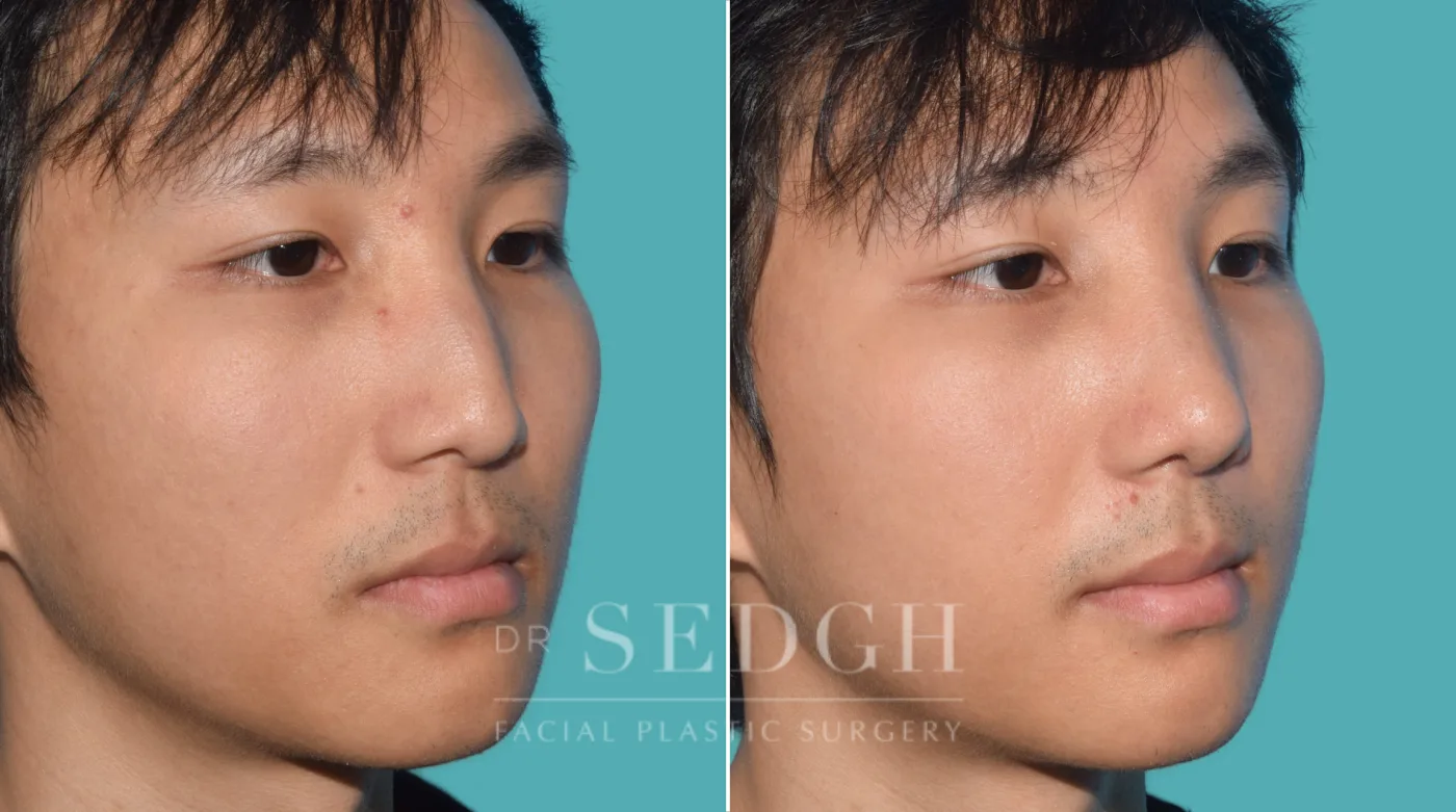 Patient 26 before Middle Eastern Rhinoplasty, view 1