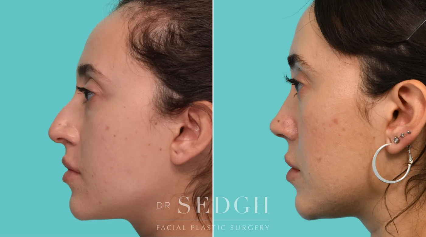 Patient 340 after Revision Rhinoplasty, view 2