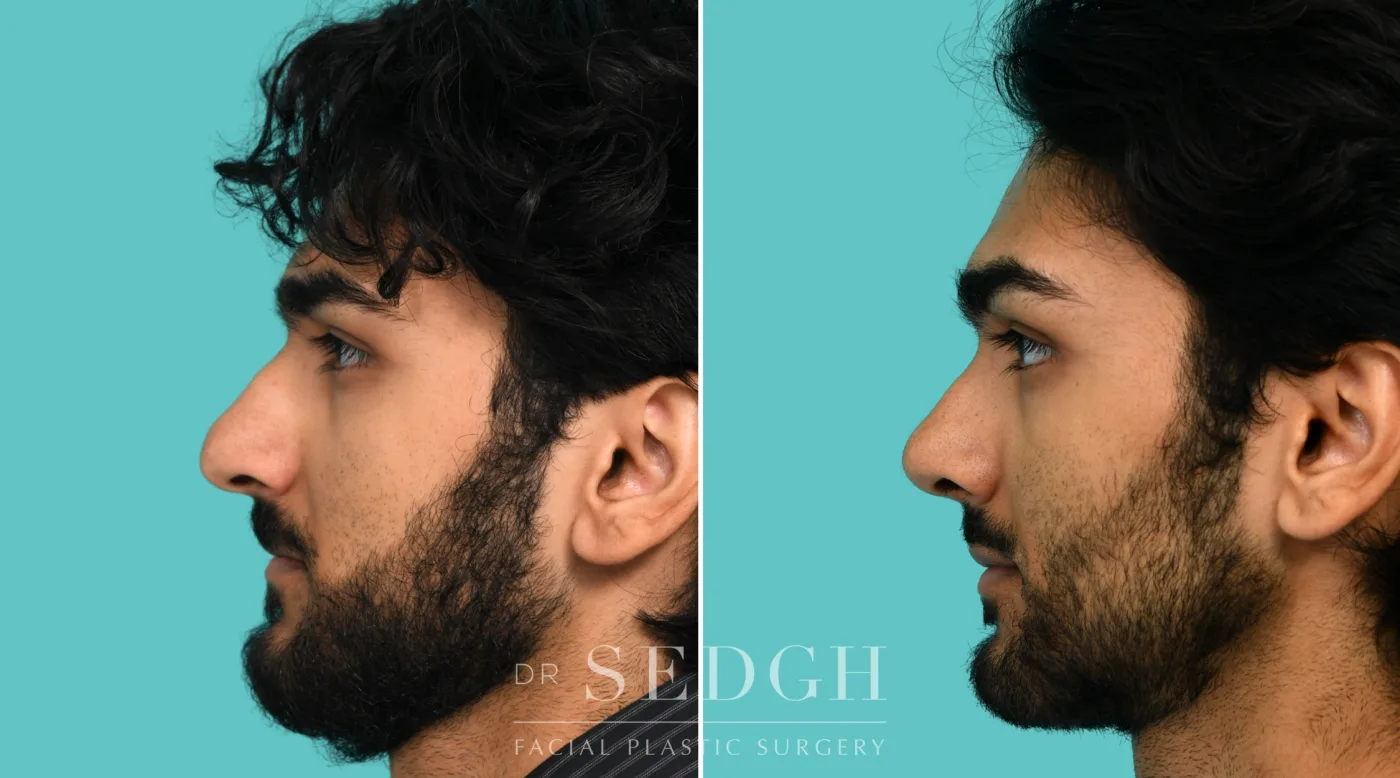 Patient 364 after Male Rhinoplasty, view 3