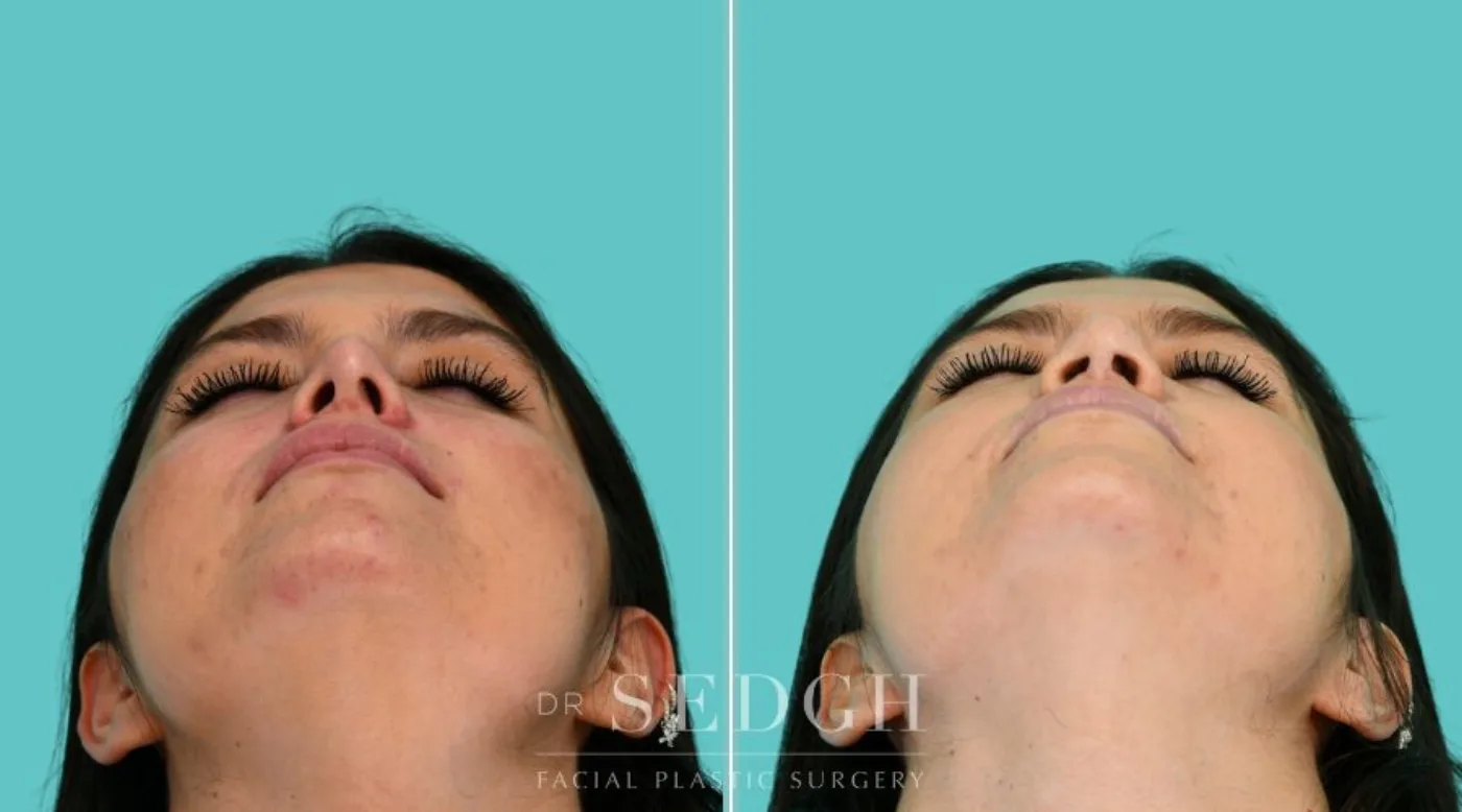 Patient 365 after Revision Rhinoplasty, view 3