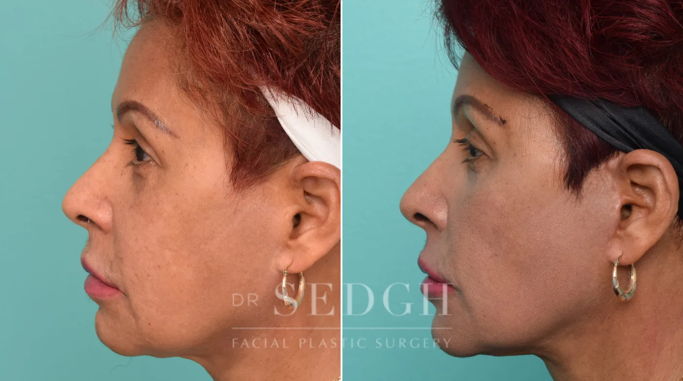 Patient 294 after Face Lift, view 1