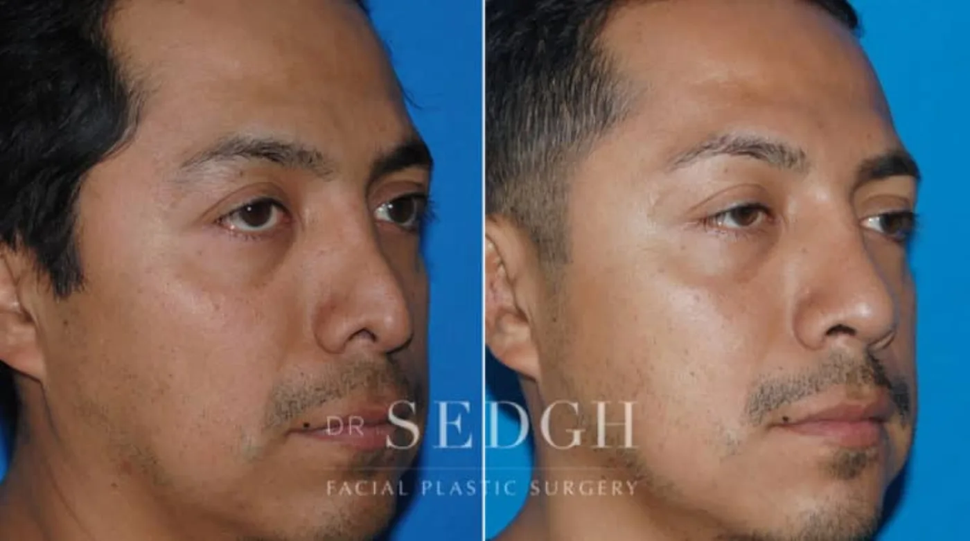 Patient 8 after Hispanic Rhinoplasty, view 1