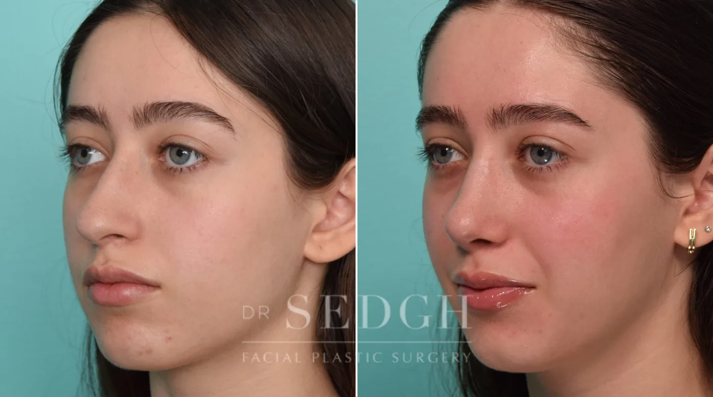 Patient 290 before Crooked Nose Surgery, view 2