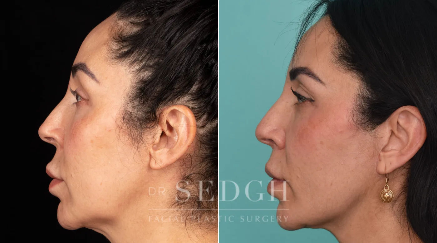 Patient 212 after Face Lift, view 2