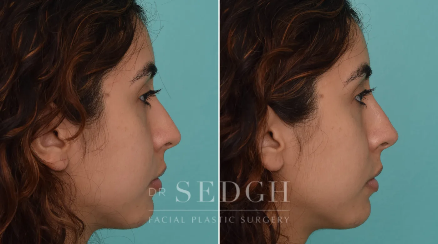 Patient 222 after Liquid Rhinoplasty, view 1