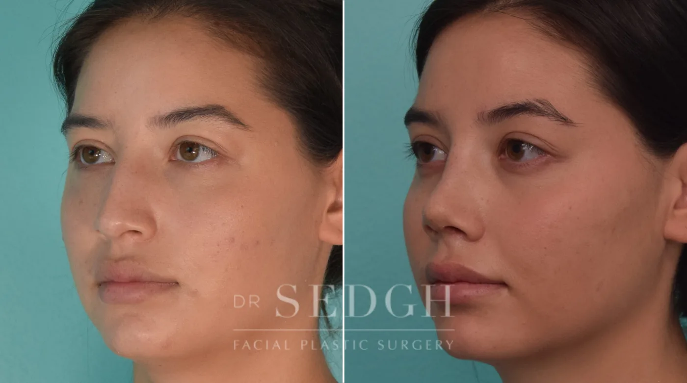 Patient 191 before Female Rhinoplasty, view 1