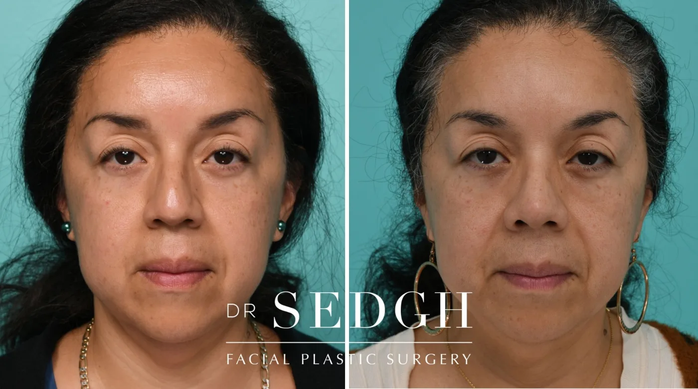 Patient 334 after Female Rhinoplasty, view 3