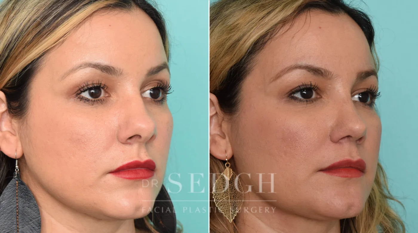 Patient 260 before Rhinoplasty, view 2