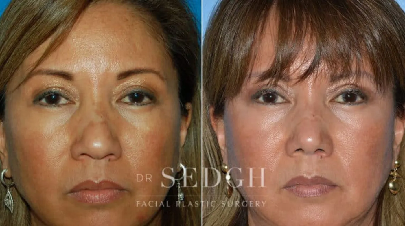 Patient 6 after Hispanic Rhinoplasty, view 1
