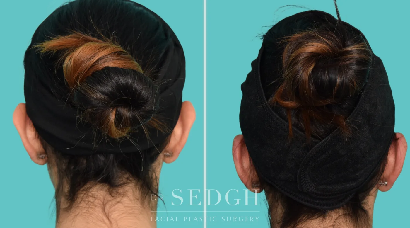 Patient 362 before Flat Helix Repair / Helical Reduction Otoplasty, view 3