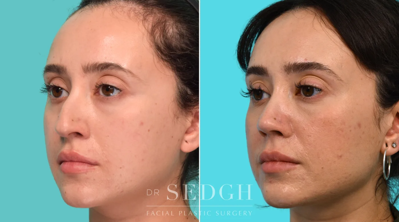 Patient 340 after Revision Rhinoplasty, view 1