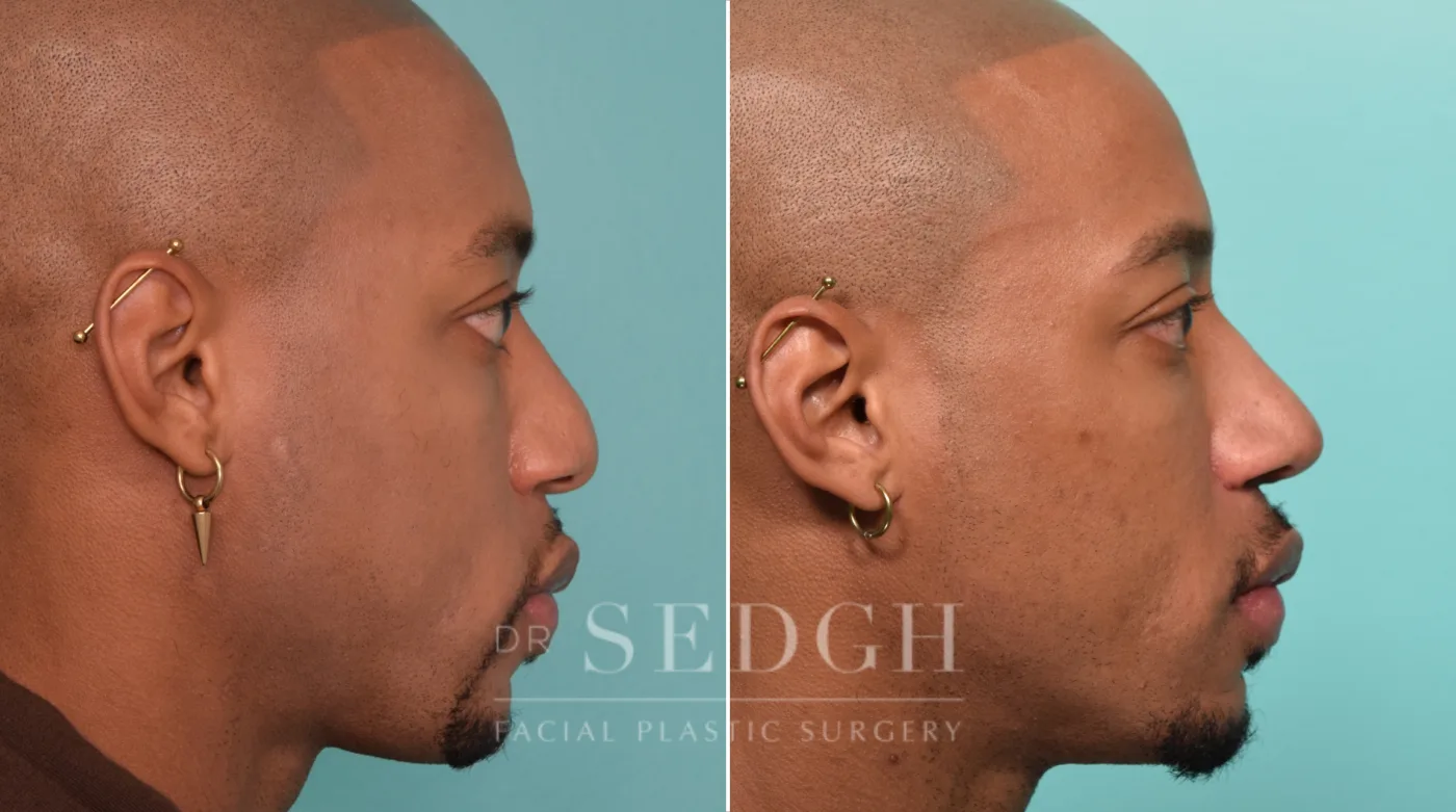 Patient 22 after Male Rhinoplasty, view 2