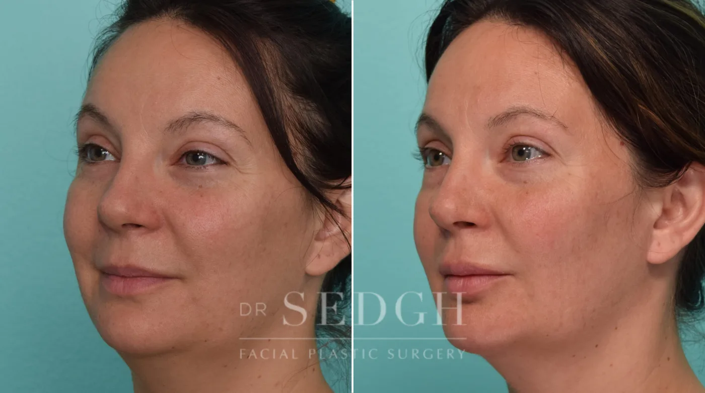 Patient 310 before Chin Augmentation, view 1