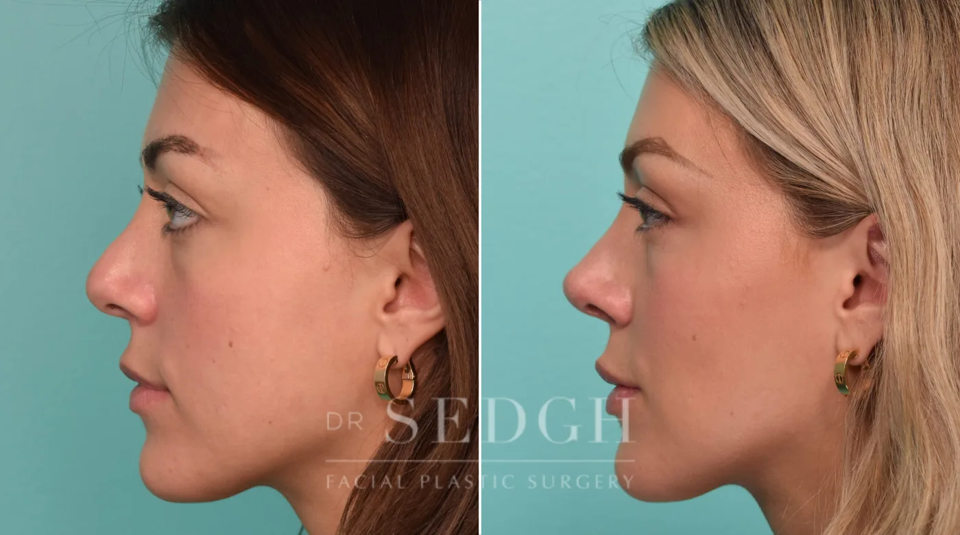 Patient 279 after Revision Rhinoplasty, view 2