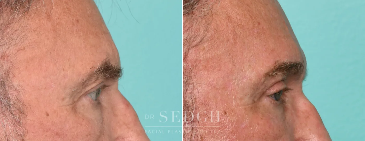 Patient 315 after Upper Blepharoplasty, view 2
