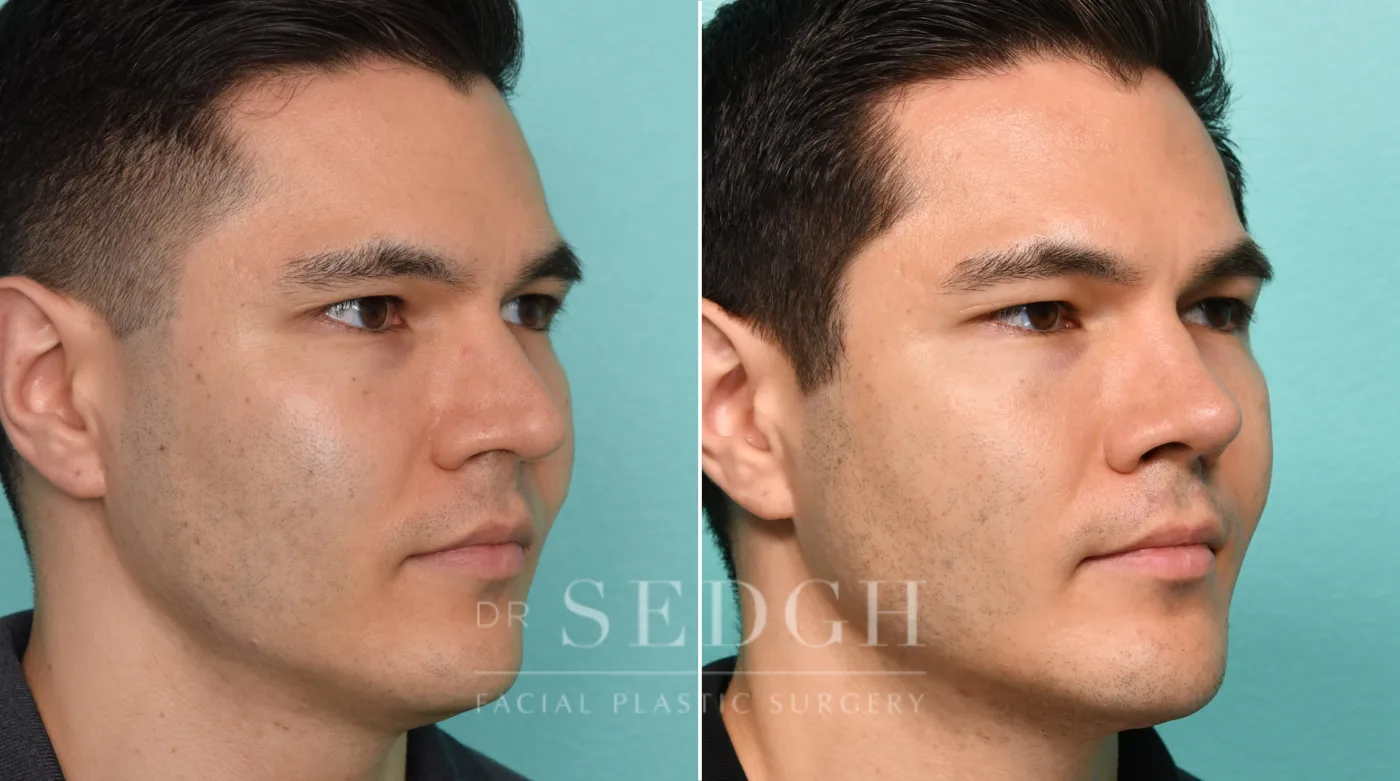 Patient 306 before Chin Augmentation, view 1