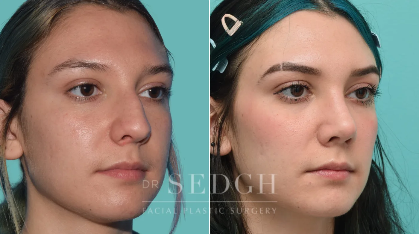 Patient 32 before Rhinoplasty, view 1