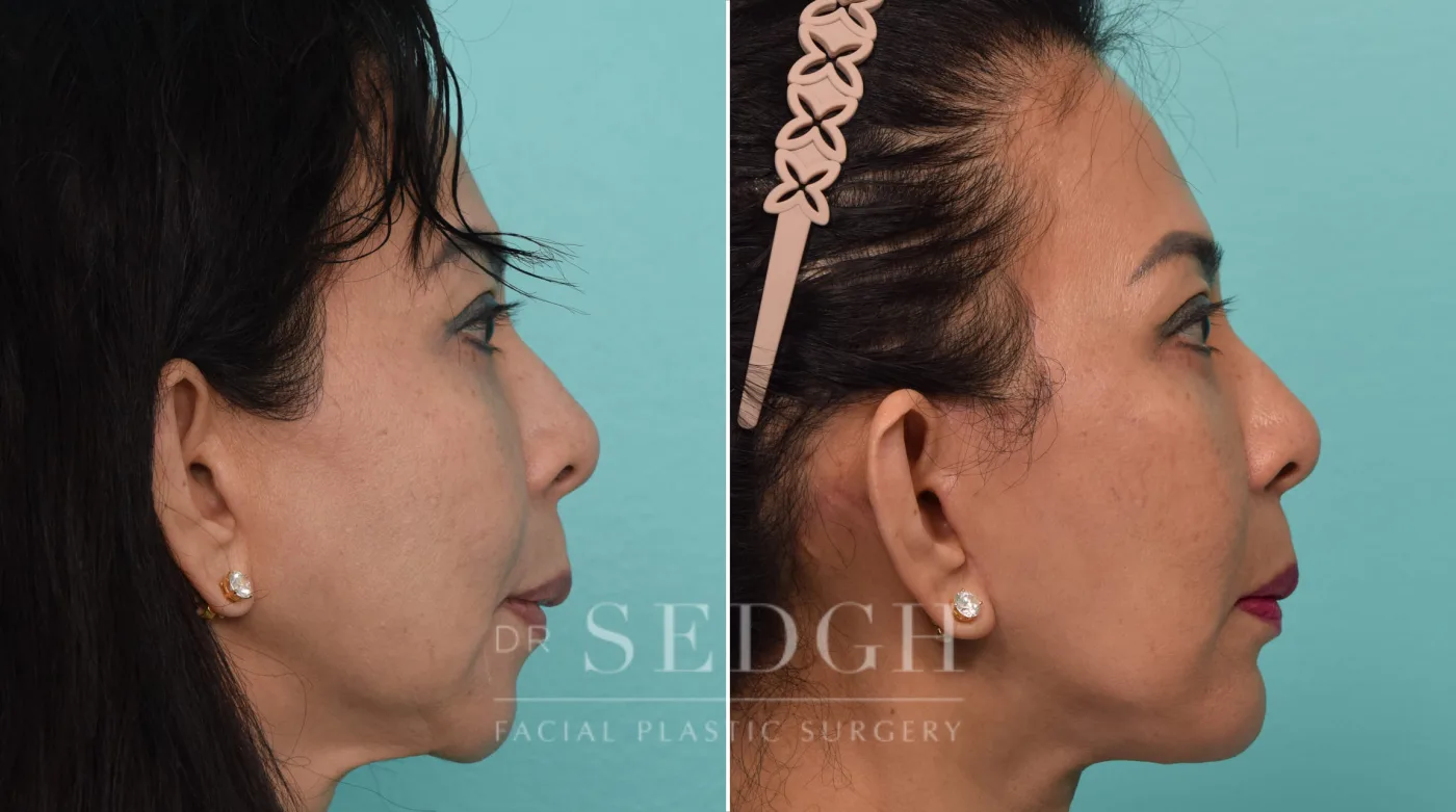 Patient 291 after Face Lift, view 1