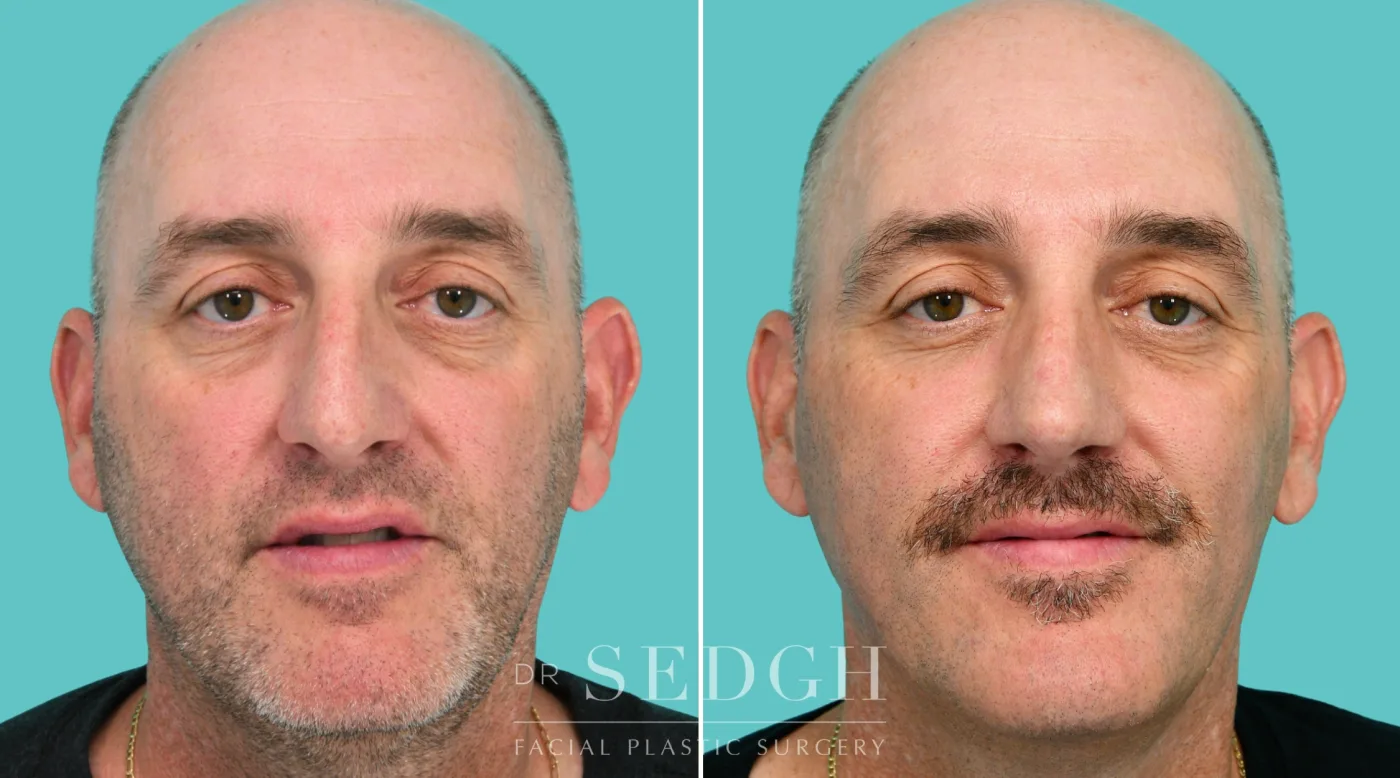 Patient 343 before Crooked Nose Surgery, view 1