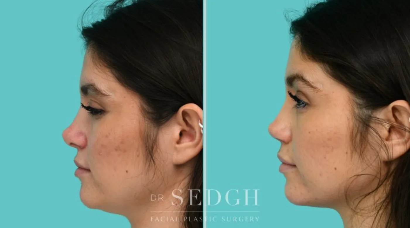 Patient 365 before Revision Rhinoplasty, view 3