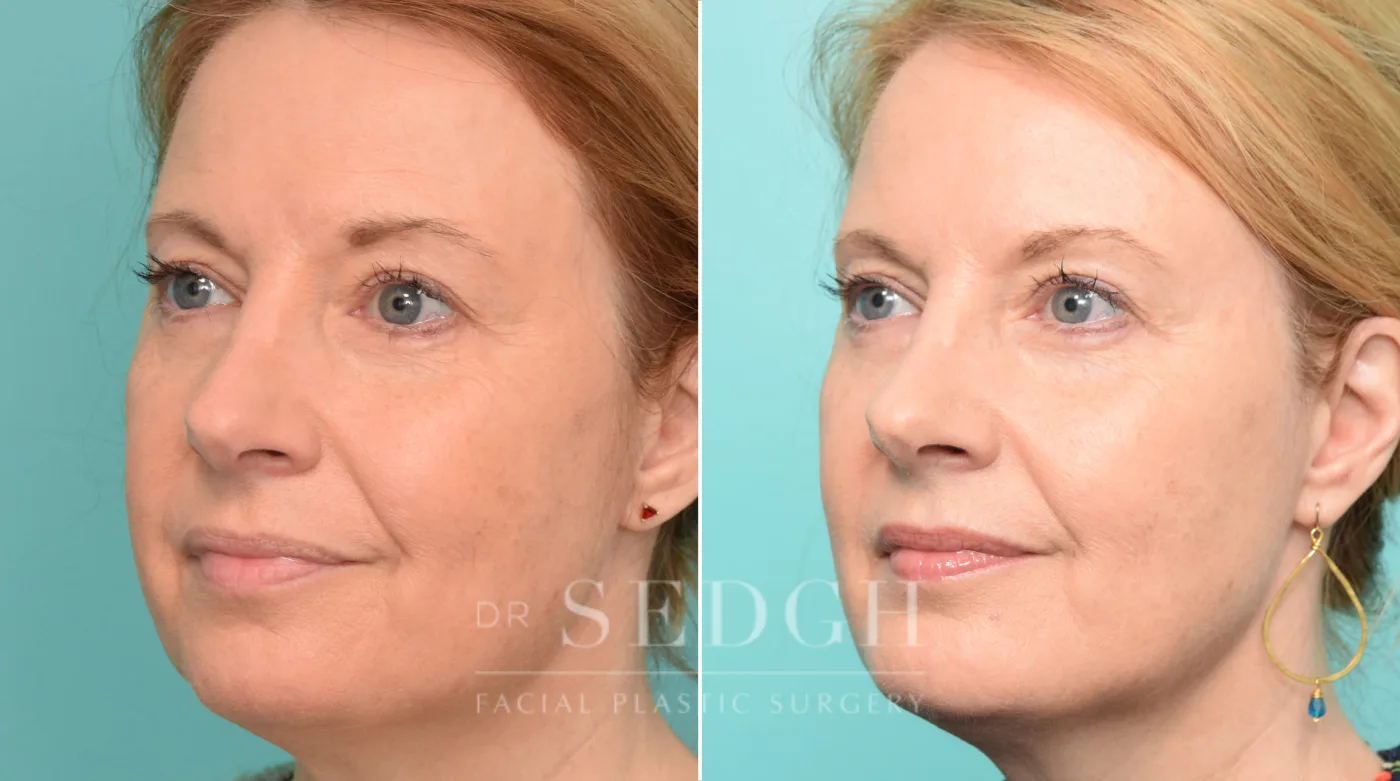 Patient 281 before Chin Augmentation, view 1