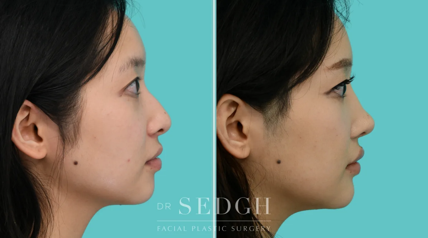 Patient 353 before Asian Rhinoplasty, view 1