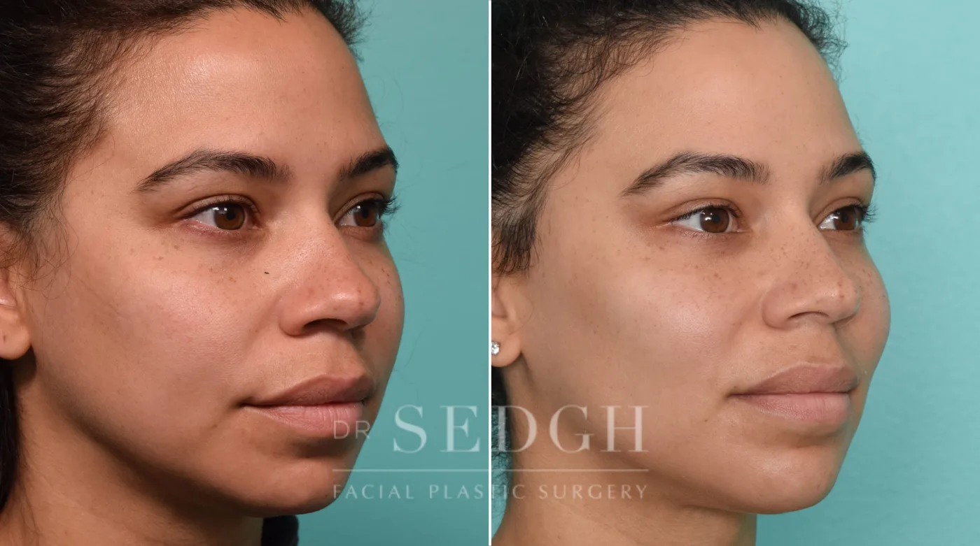 Patient 261 before Neck Liposuction, view 1