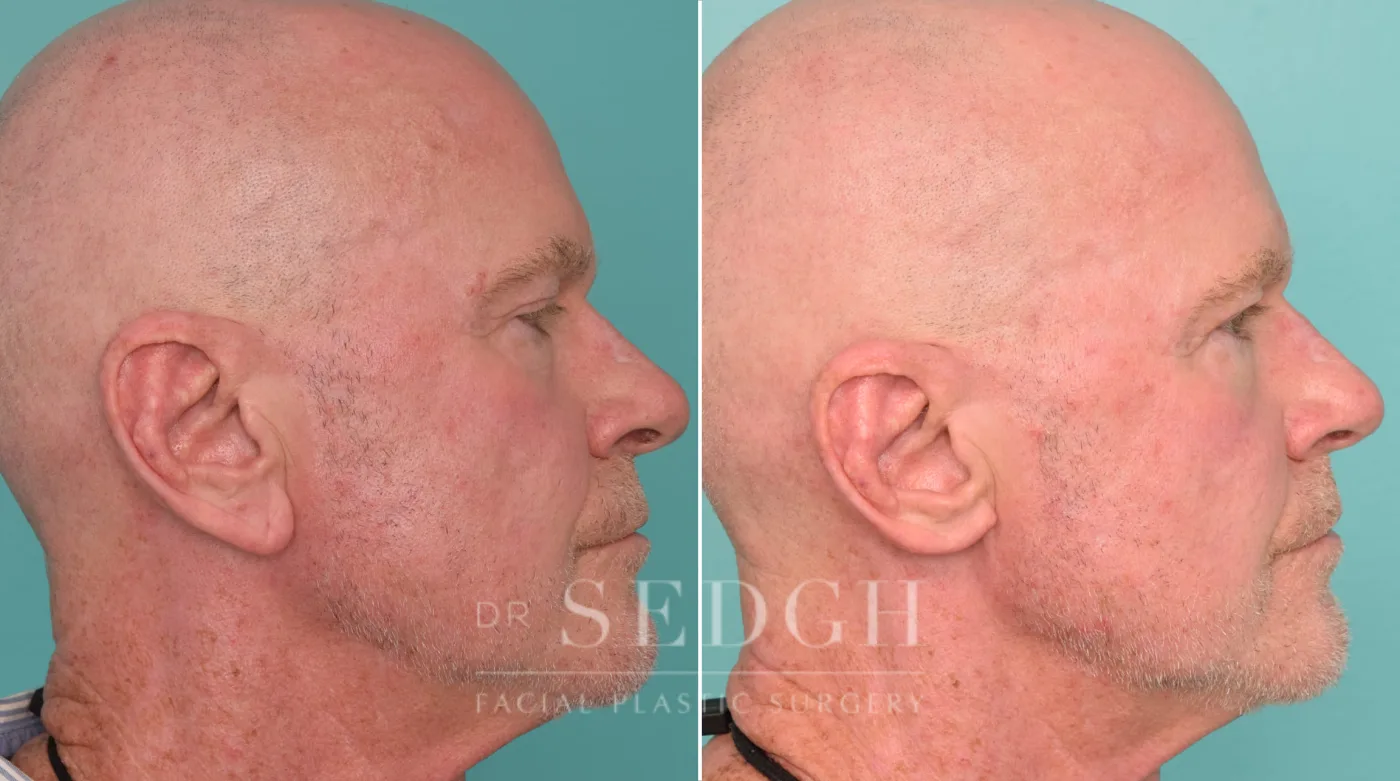 Patient 2 after Ear Lobe Reduction, view 1