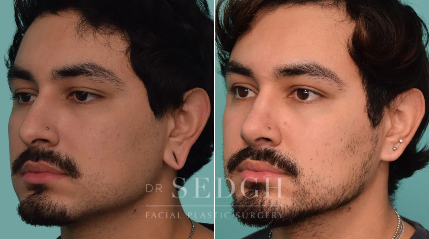 Patient 228 before Ear Lobe Repair, view 1