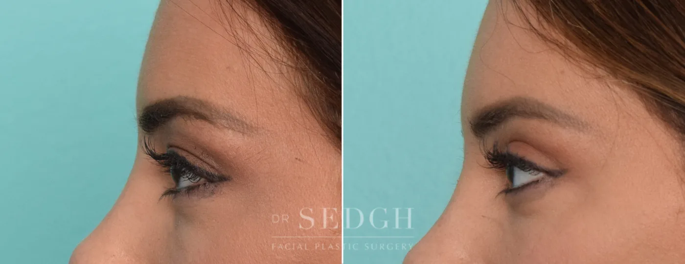 Patient 331 after Upper Blepharoplasty, view 1